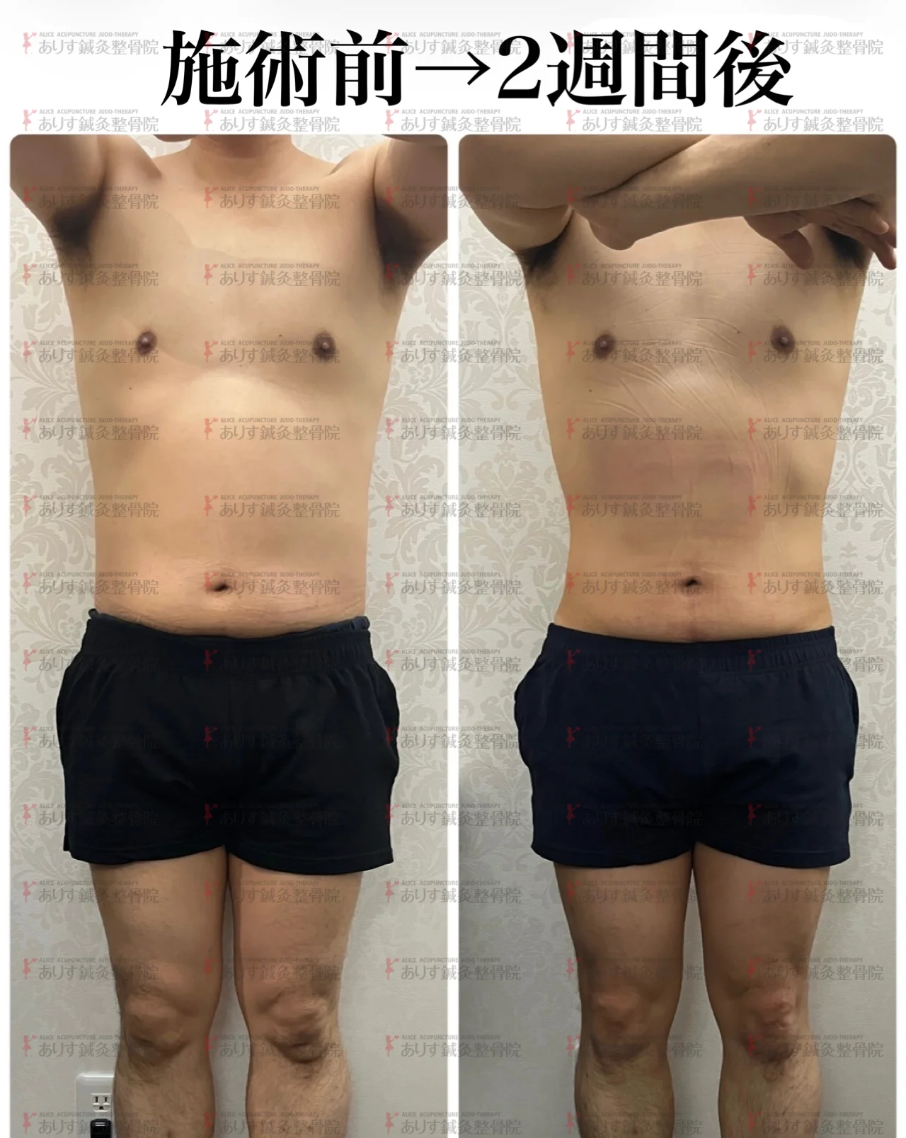 40代男性!最速!1カ月後－10.5㎝！お腹周りが脂肪冷却で激変！|高松市
